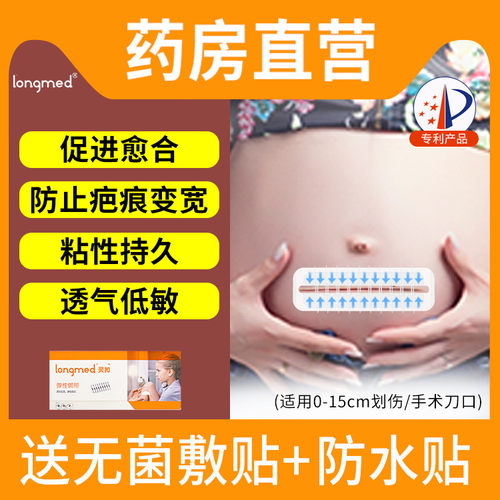 灵扣减张器剖腹产伤疤变窄