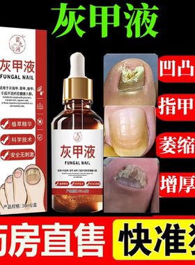 【药房正品】灰甲液指甲凹凸不平空甲发黄增厚裂甲指甲修护液lk5