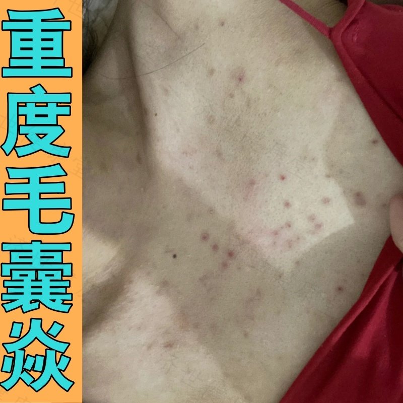 后背长痘痘毛囊皮肤炎痒止外用乳膏前胸有痤疮真菌感染过敏药