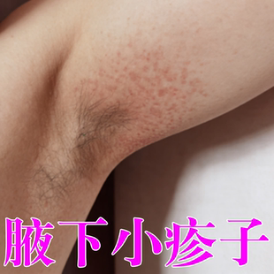 腋窝淹了起小疹子刺痛天热出汗多腋下磨红小疙瘩咯吱窝烂疼膏