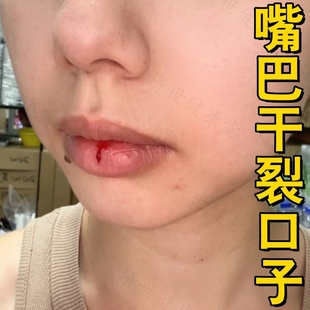 嘴唇干裂口子疼修复药局部有过敏性唇皮肤炎糜烂水肿红痒外用软膏