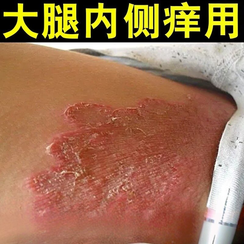 治大腿内侧皮肤痒修复的药去男士私处感染痒腿根潮湿红疹外用软膏