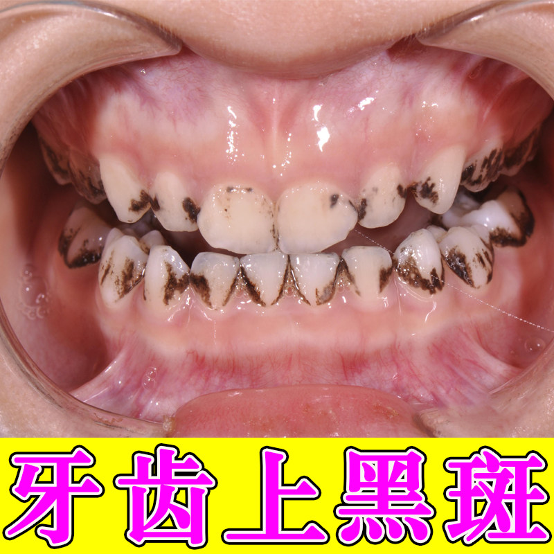 牙齿黑斑去缝隙黑渍牙窝沟清洁牙菌斑冶牙齿上茶渍咖啡渍牙齿黑渍