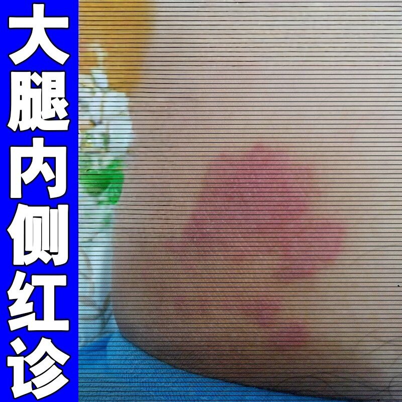 大腿内侧痒止修复药红痒疹大腿两侧感染红斑大腿根断痒王外用软膏