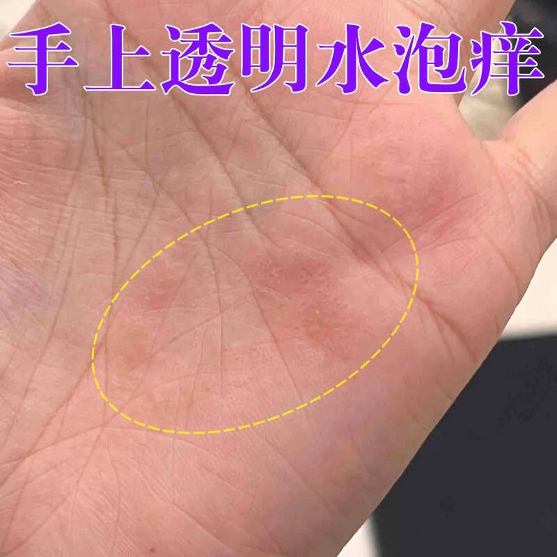手上起小水泡汗泡疱手掌起透明水泡真菌手气湿痒疹鹅掌风脱皮痒