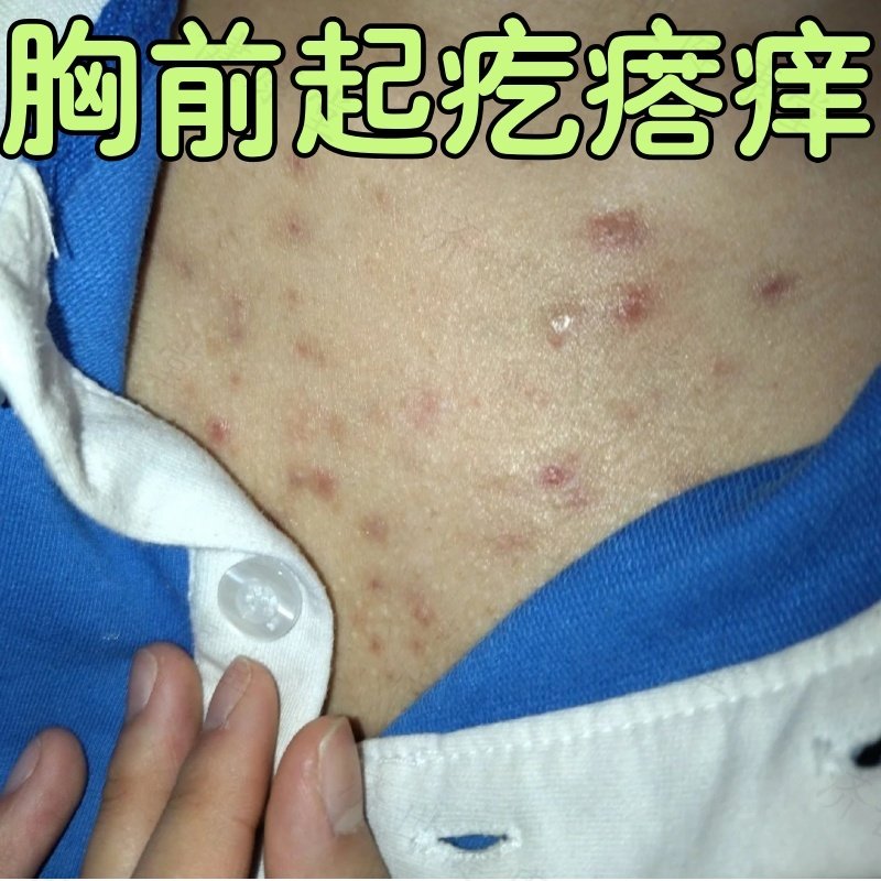 前胸后背长痘痘毛囊皮肤炎外用软膏身上有痤疮堵塞毛孔痒止药