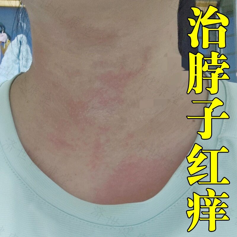 脖子红痒刺挠修复乳膏皮肤粗糙颈部过敏长藓毛囊焱角质硬化外用药
