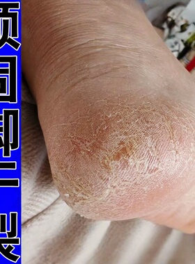 治脚后跟干裂角化型气脚角质层增厚起皮脚干痒脱皮去死皮外用软膏
