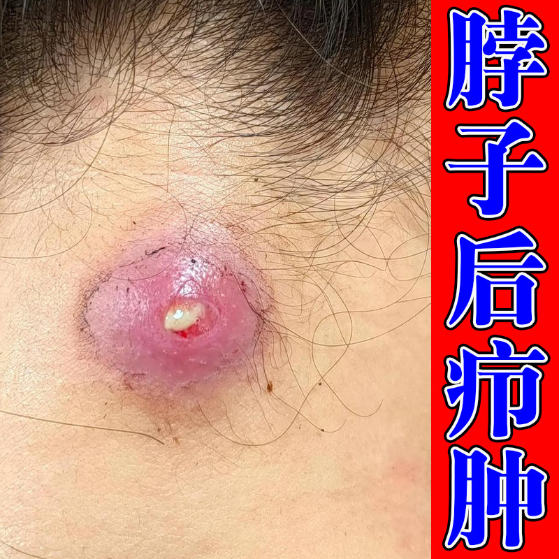 硬疙瘩脖子后边疖肿身上火疖子硬块疙瘩囊肿包流脓溃烂疼痛专用