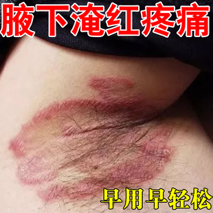 腋下痒腋窝红肿起小疙瘩痒红咯吱窝异味出汗发臭红斑淹红瘙痒泛红