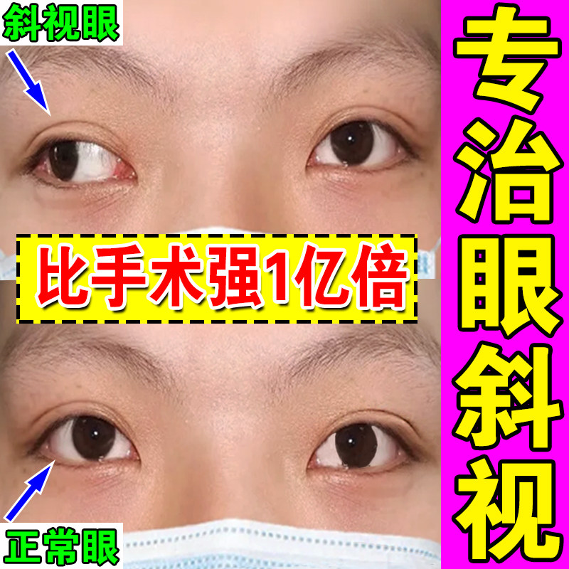 斜视矫正器训练器成人儿童内外斜视斗鸡眼聚散球纠正眼睛弱视眼贴