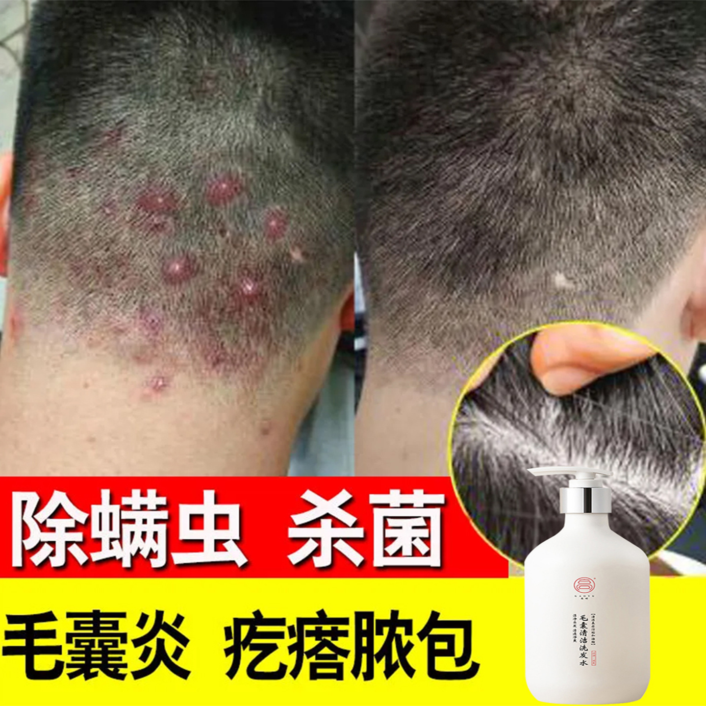 【毛囊痘痘克星】头痒头屑专用