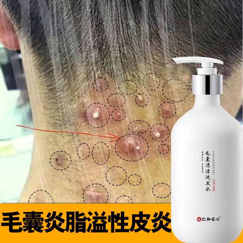 仁和匠心【毛囊炎专用洗发水】