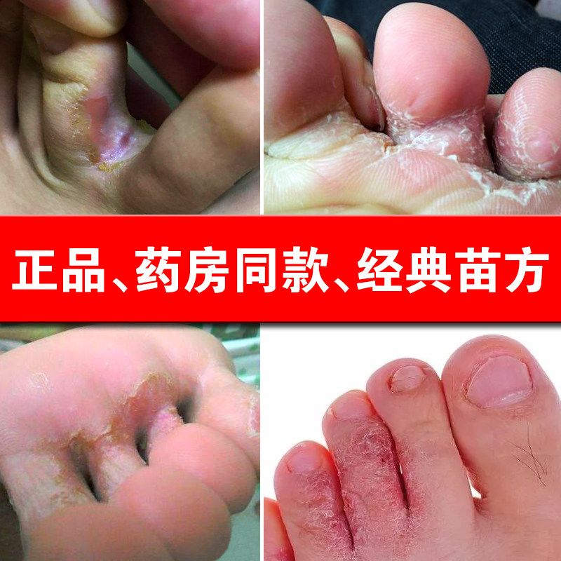 正品治烂脚指头缝去痒膏奇痒烂蜕皮脚上起小水泡烂脚丫香港足气膏