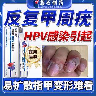 甲周疣膏儿童甲周硬皮手指疣手上长疣长瘊子寻常疣药监备案PG