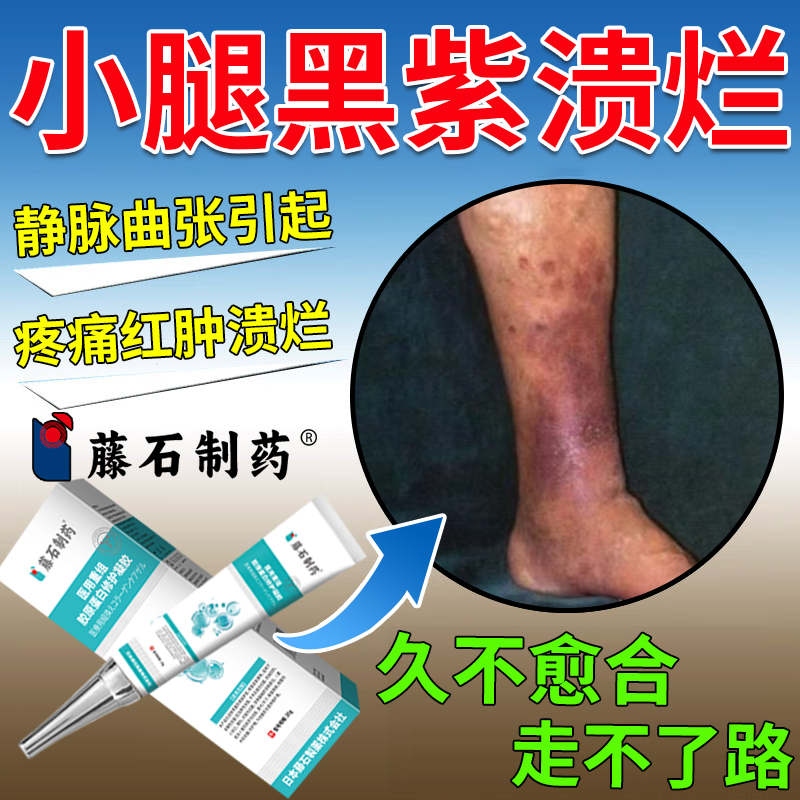 小腿下肢静脉曲张老烂腿血栓专发黑紫溃烂流脓外用溃疡药监备案PG
