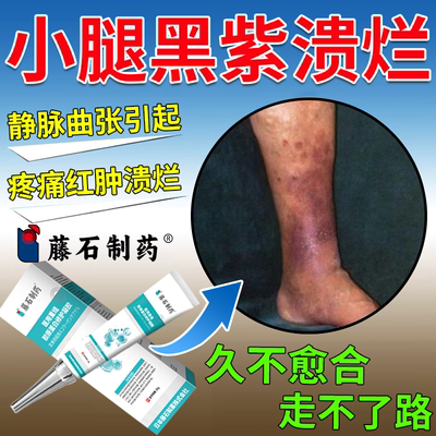 小腿下肢静脉曲张老烂腿血栓专发黑紫溃烂流脓外用溃疡药监备案PG