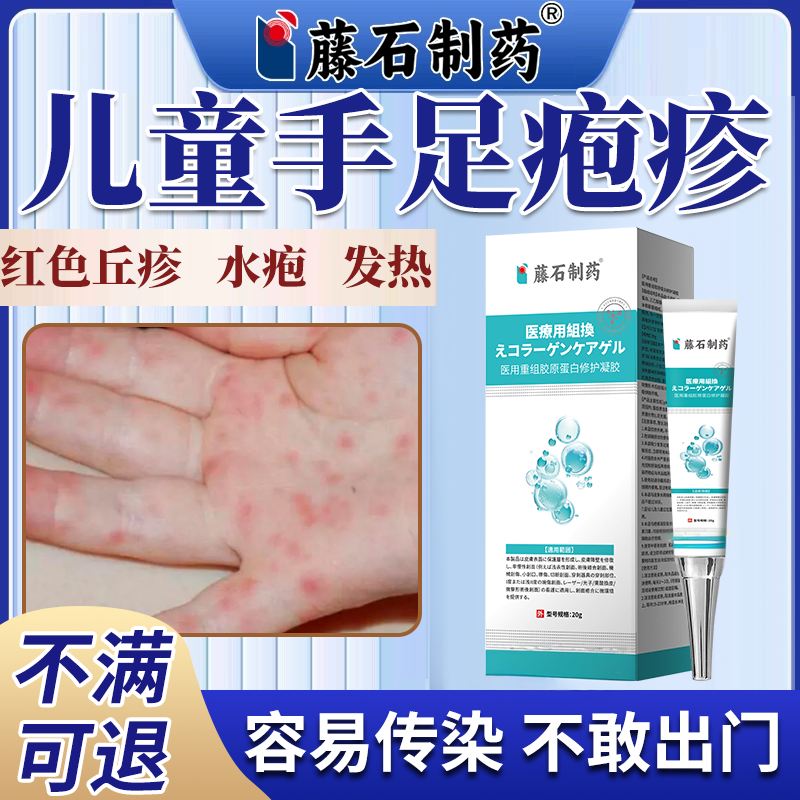 儿童手足口病疱疹药监备案膏凝胶疱疹性咽峡炎红点水疱传染疼痛PG