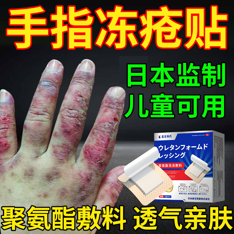 手上长冻疮手指冻疮贴根儿童药房同售水冻疮冻伤膏去液CA