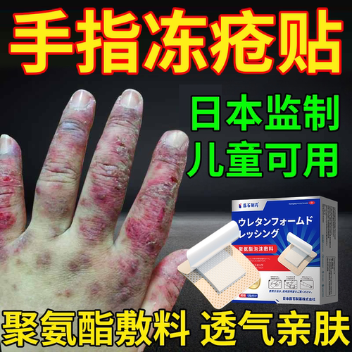 手上长冻疮手指冻疮贴根儿童药房同售水冻疮冻伤膏去液CA