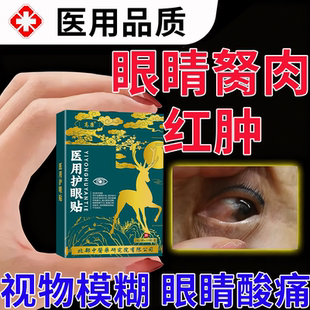 眼角长胬肉有异物感去除眼睛胬肉滴眼液眼角长翼状胬肉眼干疲劳PG