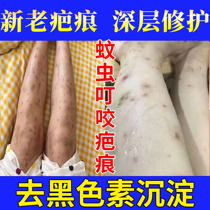 蚊虫叮咬祛疤膏腿上去疤印去黑色素沉淀儿童医用疤痕护理软膏剂XS