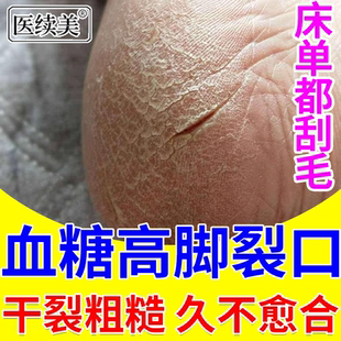 血糖高脚裂脚后跟干裂口膏足跟裂手足流血起硬皮脱皮屑药监备案PG