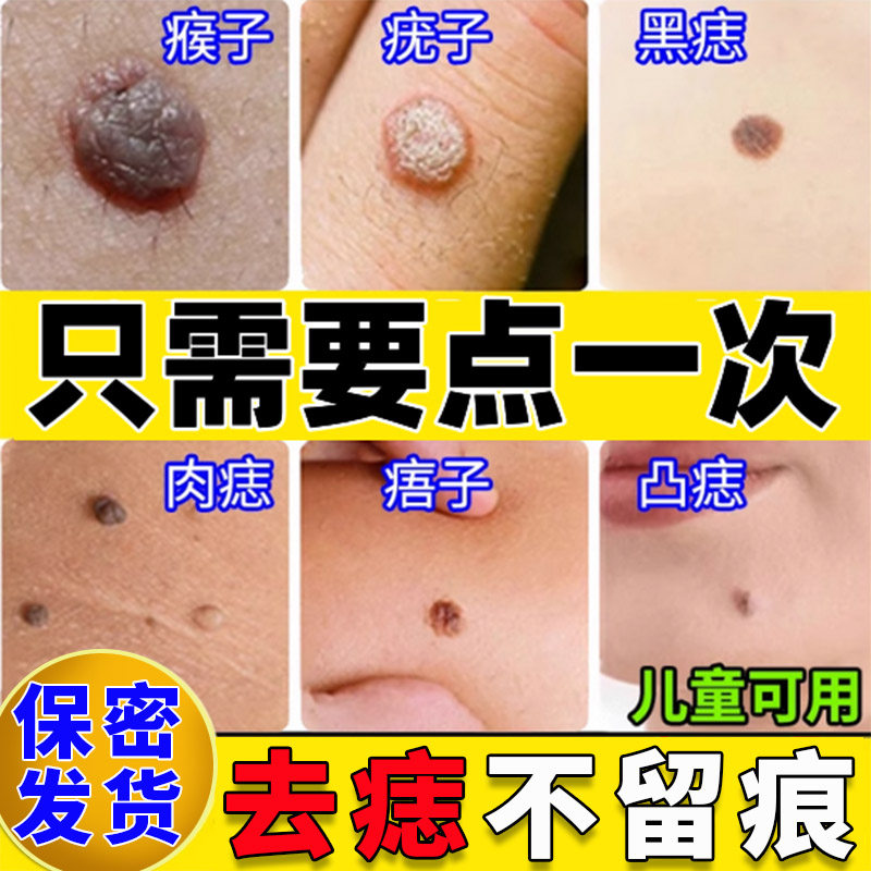 点痦子中药痦子去除神器丝状疣鸡眼点痣痦子脸部小肉粒膏药一点清