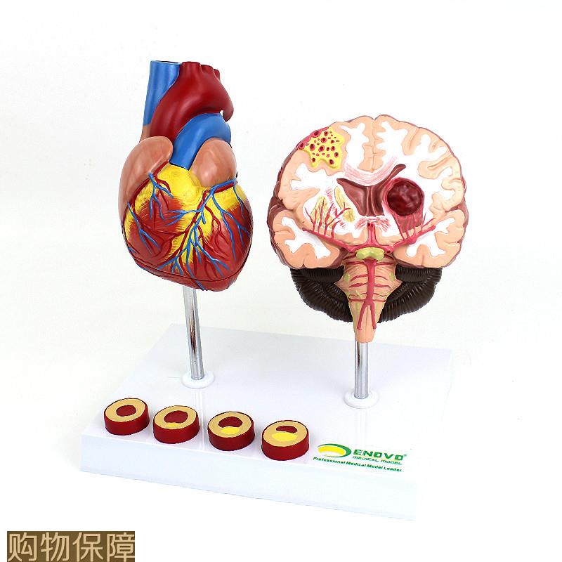 ENOVO颐诺 心脑血管疾病展示模型 高血压心脏 心血管疾病模型 脑