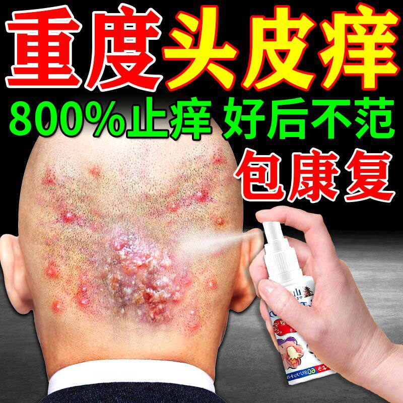 治疗头部头皮痒有疙瘩毛囊炎的药马拉色真菌感染专用特药效喷剂水