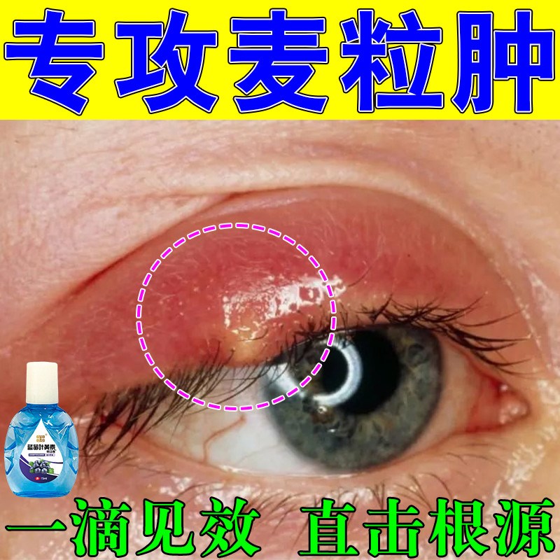 麦粒肿霰粒肿针眼滴眼液红肿脓包干涩发痒眼睑炎眼部红肿热痛水