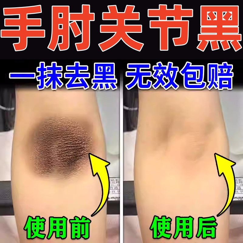 胳膊肘去黑去死皮手肘膝盖关节去黑神器皮肤黑色素沉淀去除腋下黑