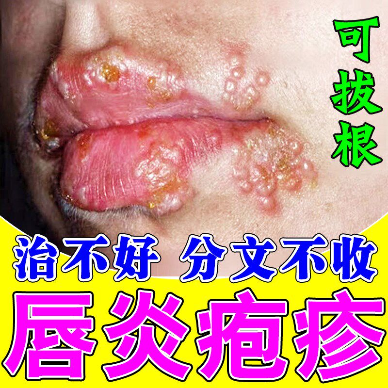 烂嘴角泡疹上火起水泡嘴唇干裂脱皮红痒嘴巴干燥起皮开裂唇炎唇膏
