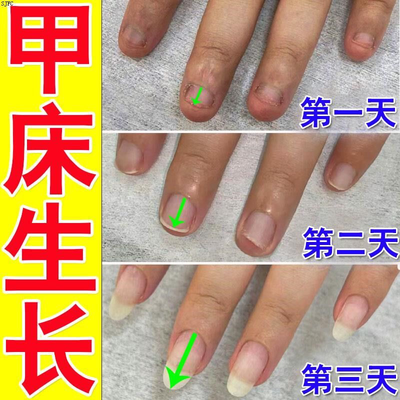 甲床修复生长液指甲受损萎缩甲肉分离空甲断裂分层护甲油甲床增长
