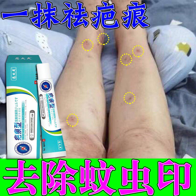 蚊虫叮咬祛疤膏去蚊子咬疤印抓痕腿上淡化黑色素修复烫伤痘坑挠印