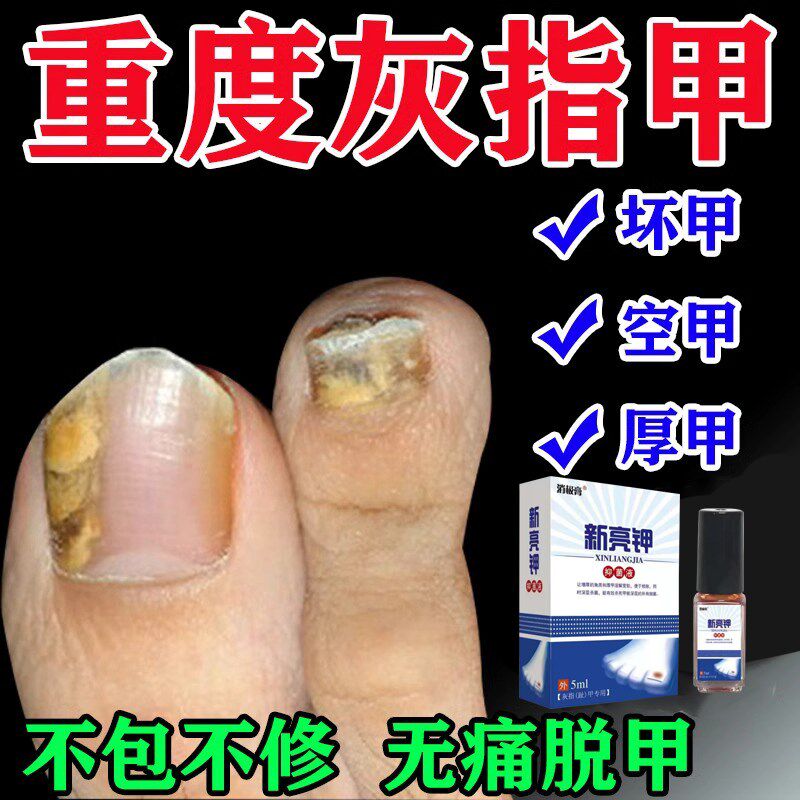 脚指甲增厚变黄灰甲神器脚趾甲变厚发黄变硬黄指甲盖坏甲变好甲药
