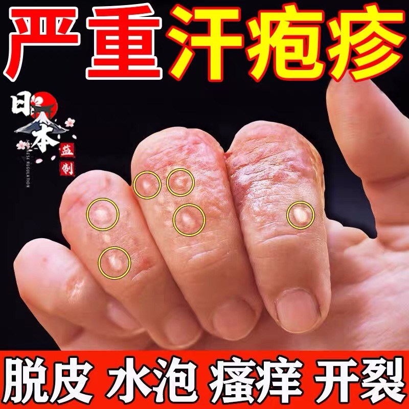 手脱皮手上起小水泡手部手痒水泡脱皮干裂季节性手气苗医药止痒膏
