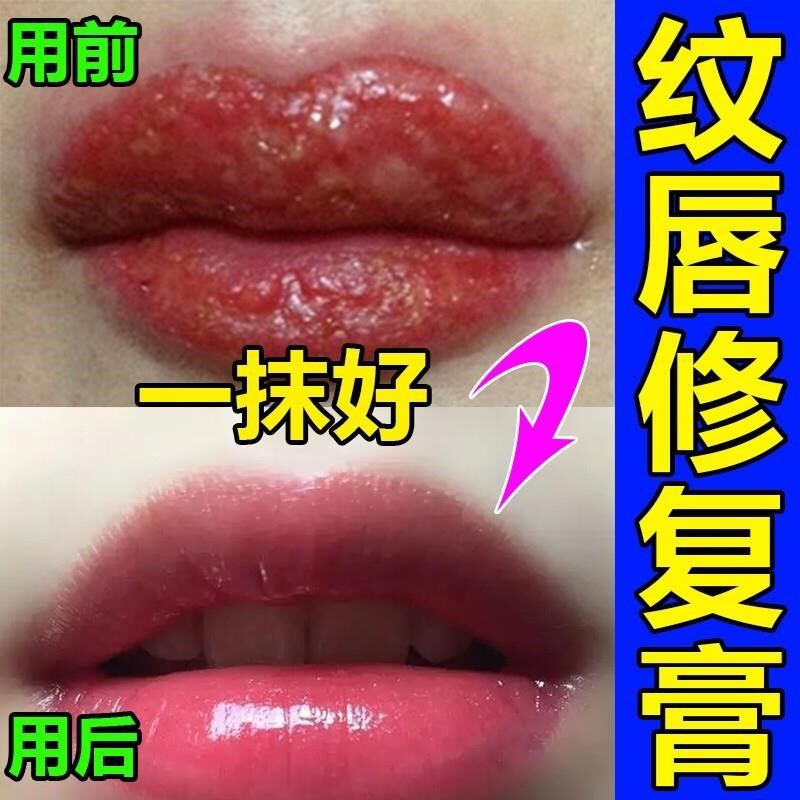 纹唇后的专用修复精华飘唇去肿固色锁色润唇膏做唇不结痂修复液剂