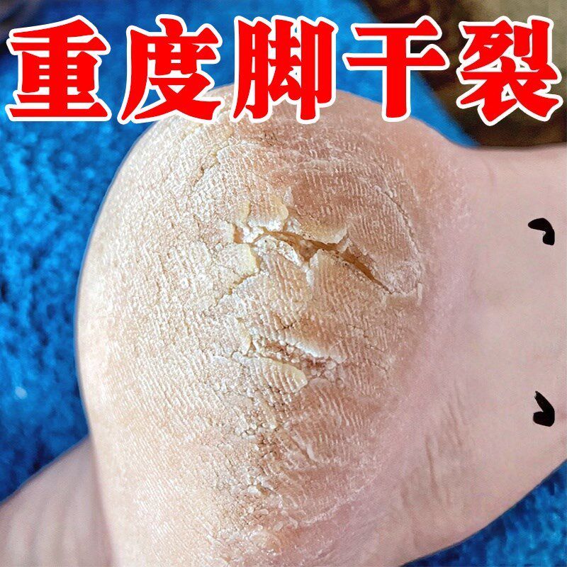 脚后跟干裂起硬皮足跟开裂治脚皲裂感染真菌脱皮裂口防裂修覆膏