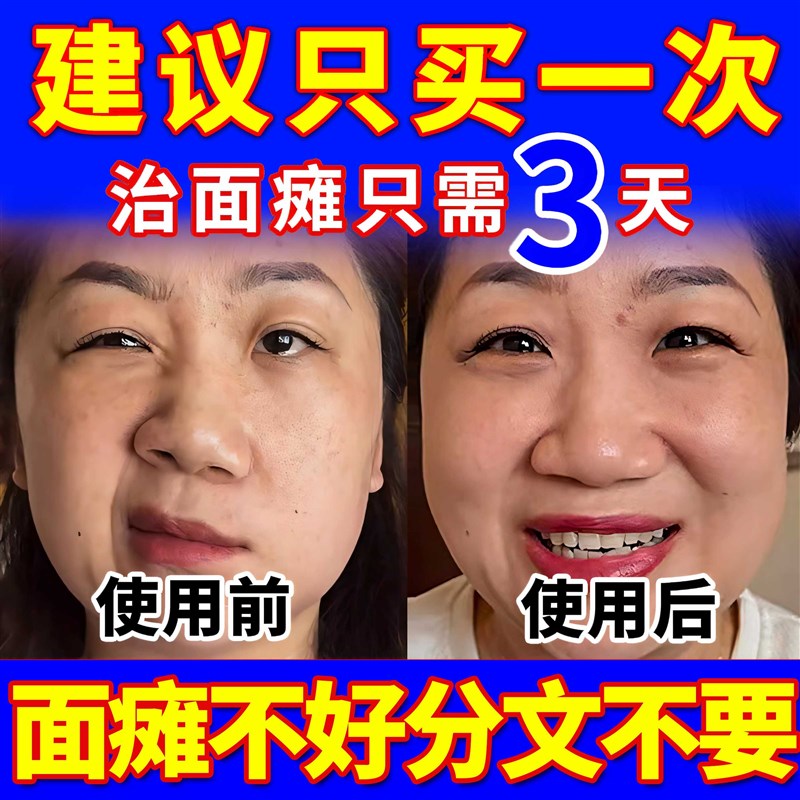 面瘫特膏贴效脸部训练神器药热敷专用牵正后遗症恢覆嘴歪眼皮痉挛