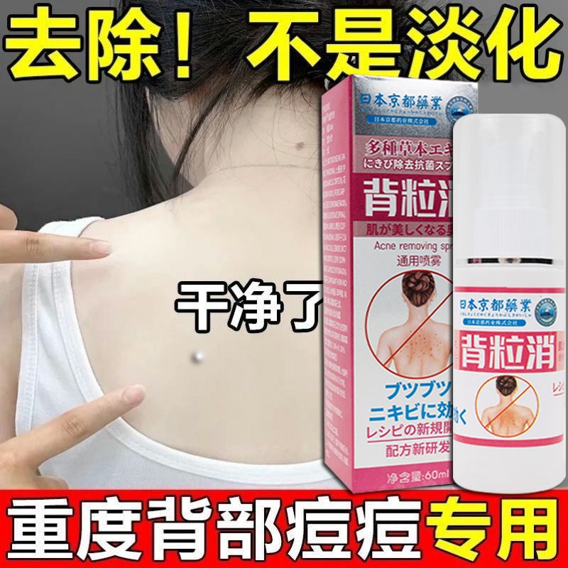 背后痘痘去除药膏去前胸背部螨虫黑头粉刺豆豆后背祛痘背上长痘痘