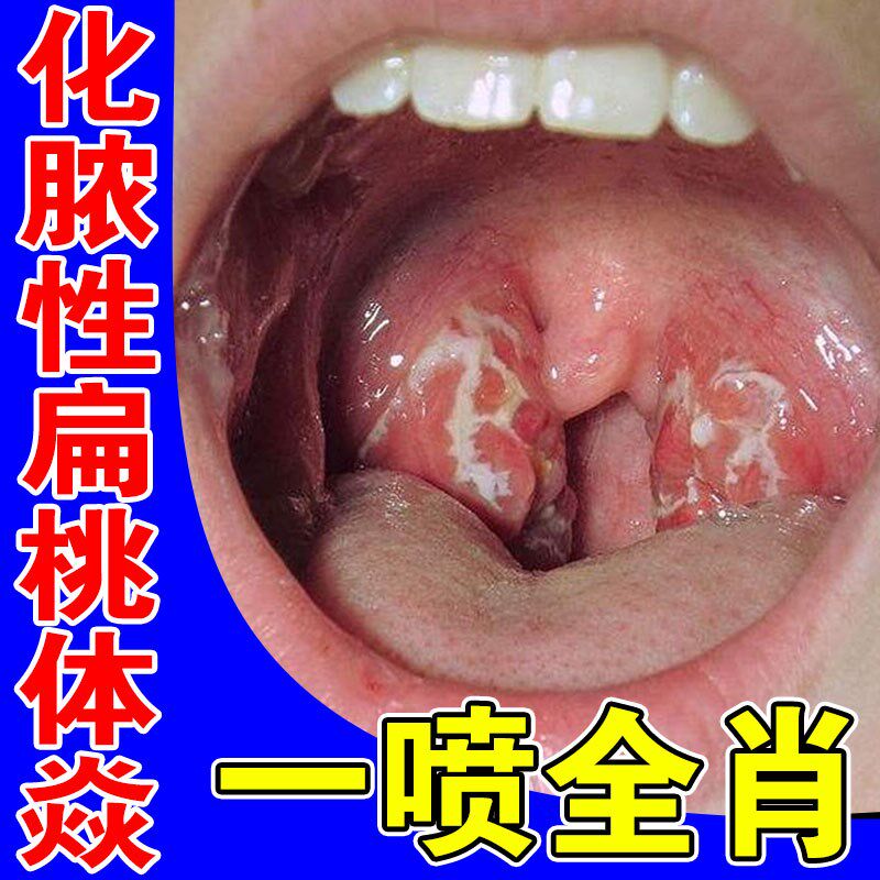 化脓性扁桃体焱喉咙有痰滤泡增生异物感专用神器慢性咽喉焱的药物