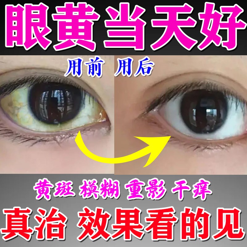 黄斑病变眼眼睛水肿裂孔底部发黄浑浊眼白眼球清澈去黄去浑眼贴