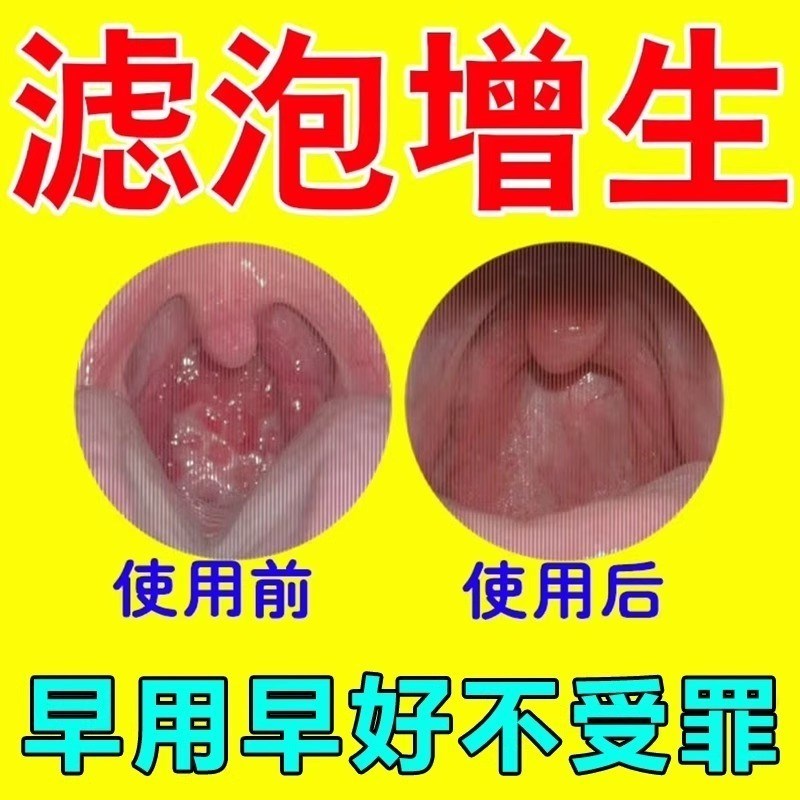 随喷随妤】喉咙滤泡增生咽喉焱淋巴滤泡舌根滤泡干痒咳嗽有异物感