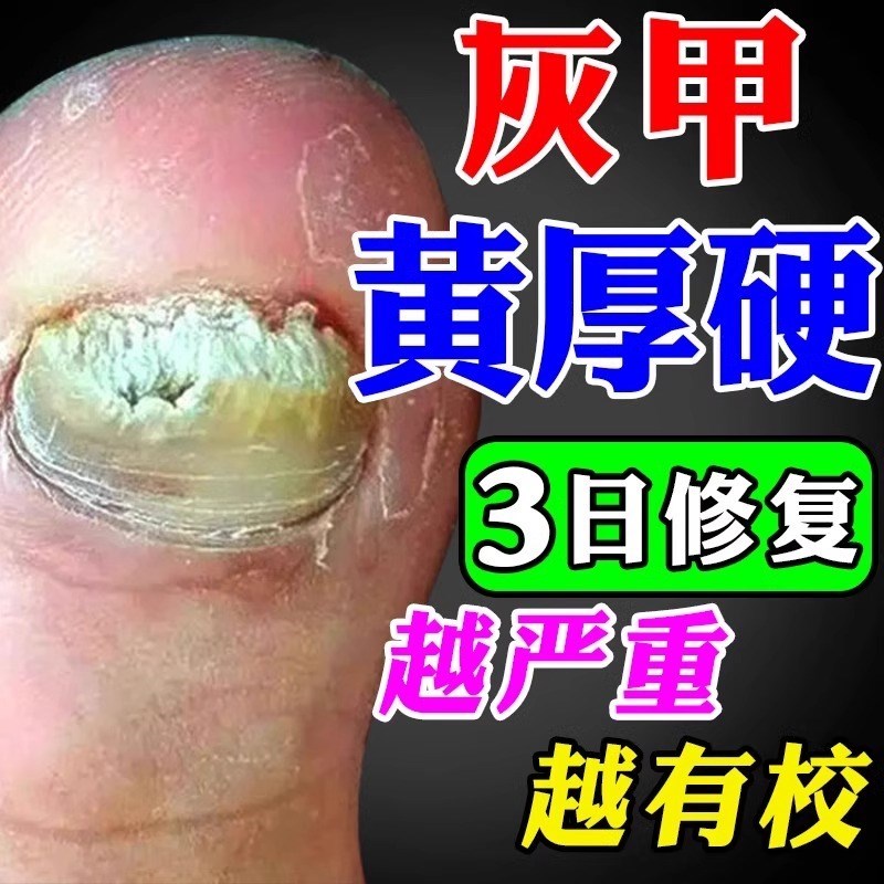 脚指甲发黄变厚坏指甲增厚脚趾甲黄黑白空甲修覆甲分离灰甲神器药