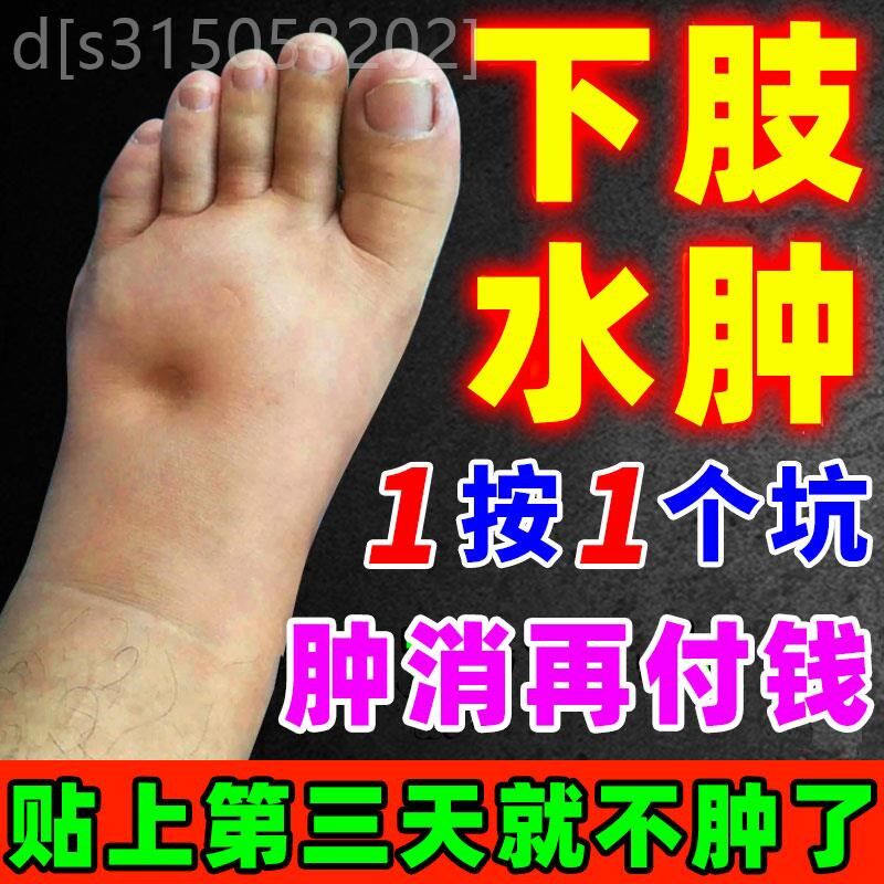 下肢水肿腿脚水肿利尿排水肿小腿全身浮肿水肿贴纯中草药走路困难