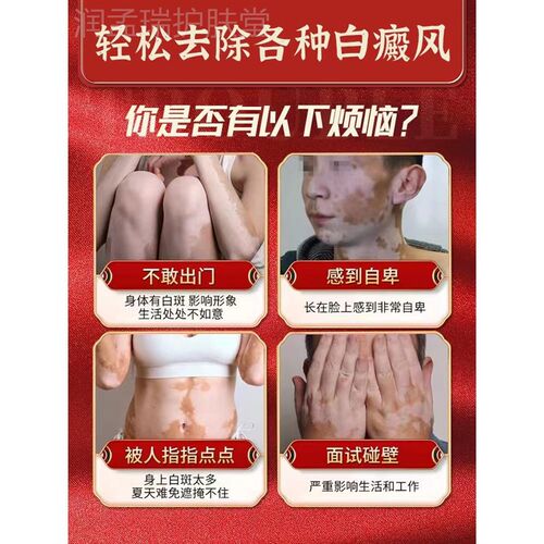 【一抹肖滁】白癜风外用黑色素生长药膏皮肤快速消白斑专用神器YN