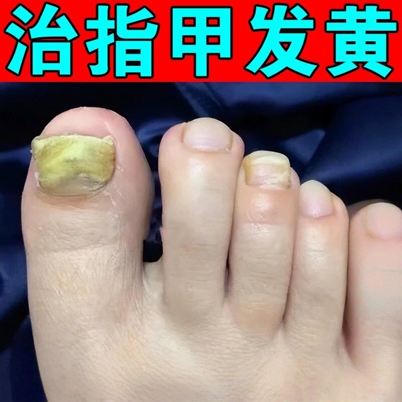 指甲增厚修复液手脚指甲发黄变厚硬灰指甲肉床分离脱落软化修护液