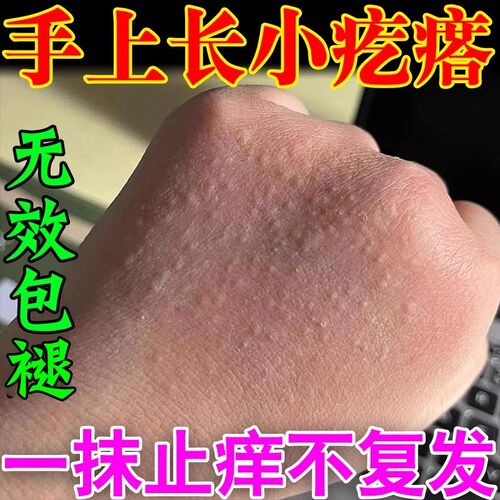 手癣手脱皮干裂汗泡疹足藓鹅掌风手上起小水泡手痒真菌感染止痒膏