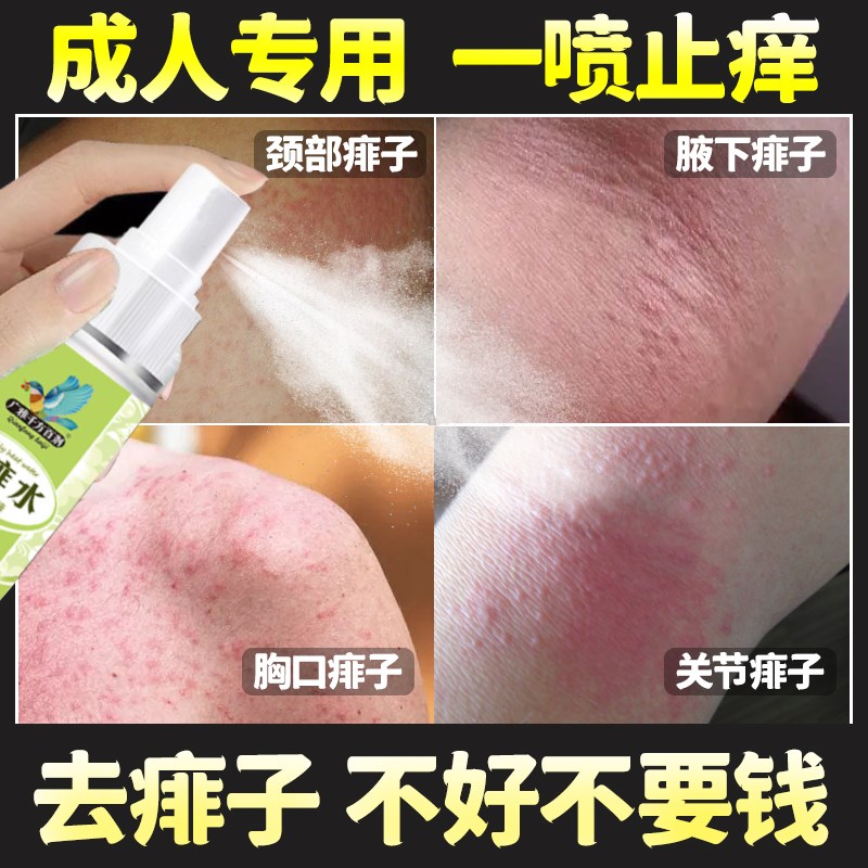痱子止痒水成人除热痱子神器药治去菲喷雾祛痱膏大人身上起红痱长